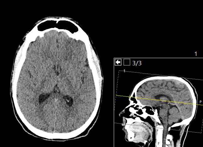 CT scan of the brain, axial slice
