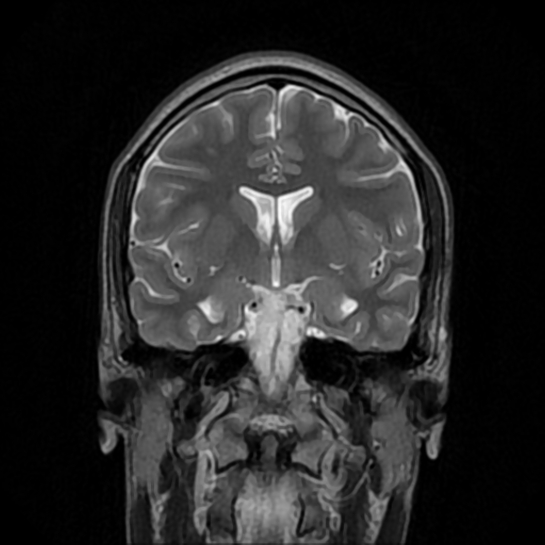 MRI scan of the brain, axial slice