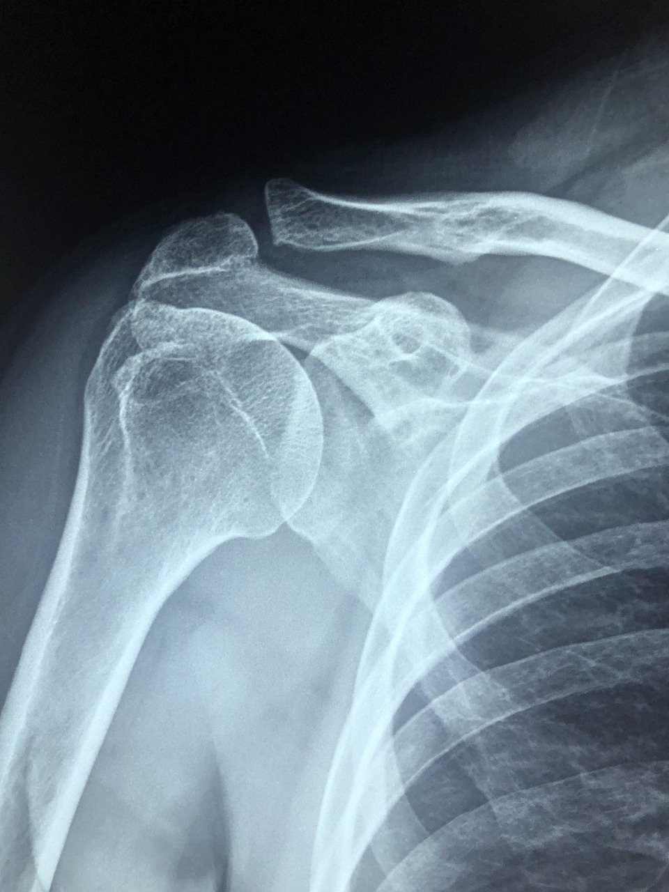 Shoulder radiograph from the claim file