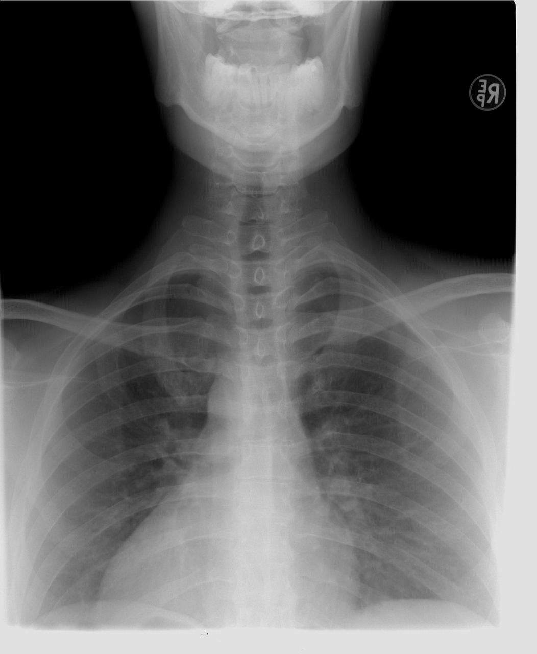 Spine radiograph from the claim file