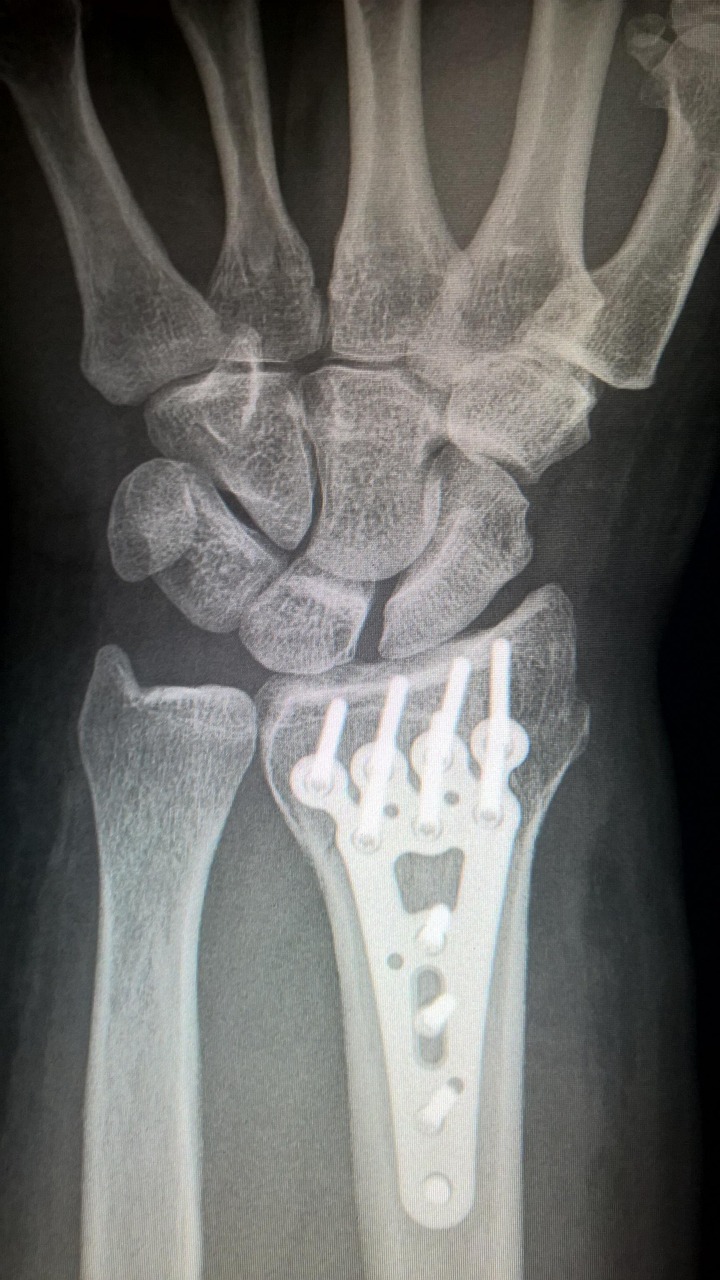 Wrist radiograph showing plate fixation, from the claim file