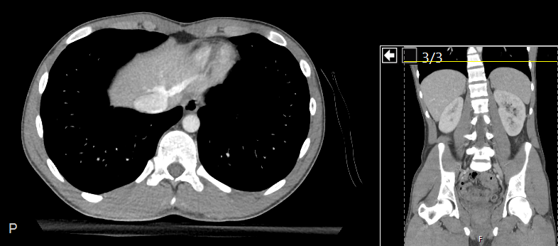 CT of the abdomen, single slice