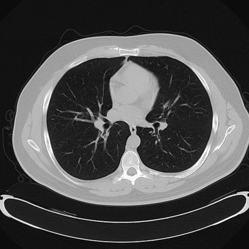 CT of the chest, single slice