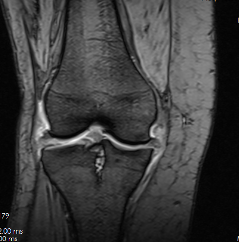 MRI of the left knee, single slice