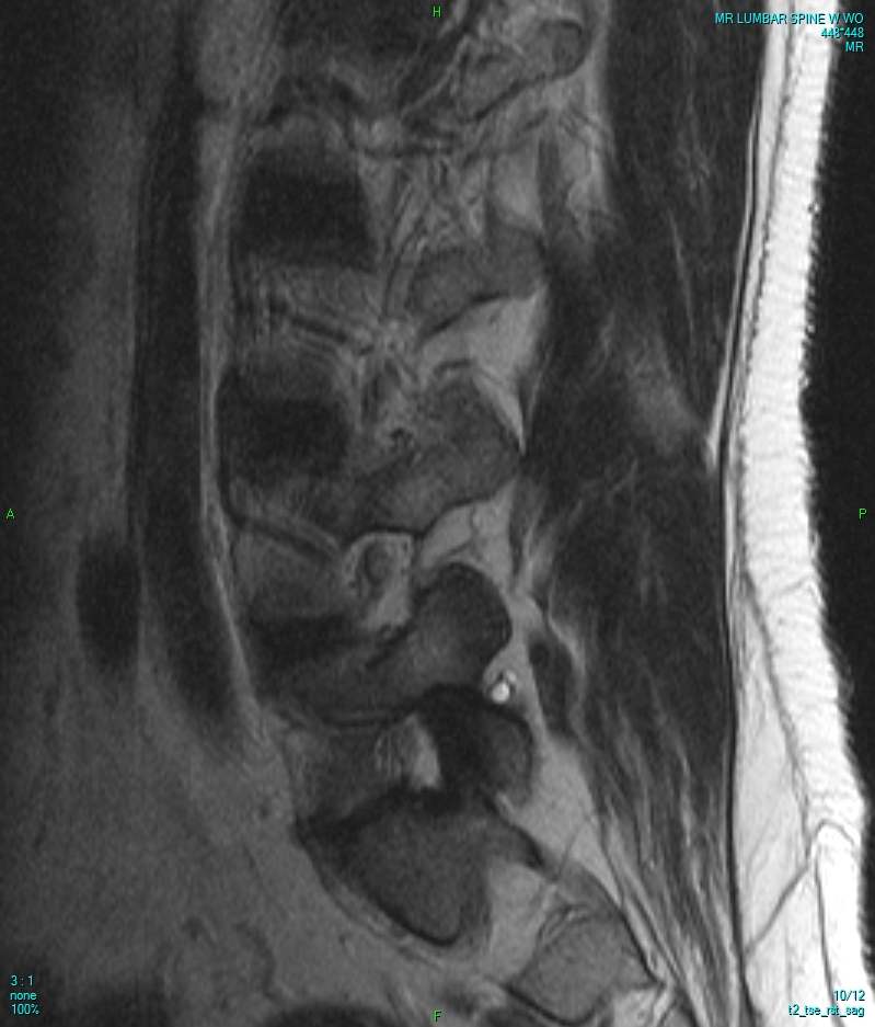 MRI of the lumbar spine, single slice